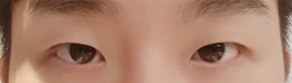 男性の二重手術10日〜レビュー（目つき矯正（非切開）、目頭切開）