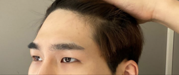 目つき矯正と額リフトを受けて5ヶ月後のレビューです！