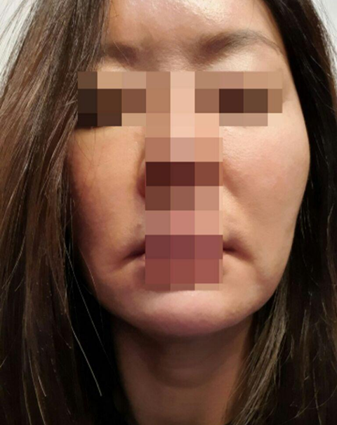 目の下の脂肪移植、フェイスリフト