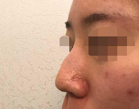 手術を受けて4ヶ月後のレビューです!! ᄒᄒᄒ