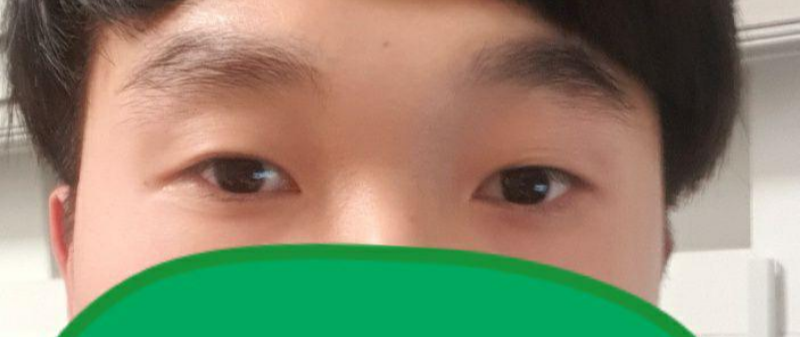 部分切開による目つき矯正、目尻切開手術を受けました。