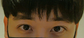 二重まぶた切開、目つき矯正、ラインを低くする