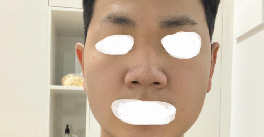 こんにちは。鼻の手術をして1週間目です