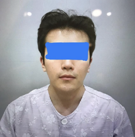 エラ削り、頬骨縮小、顎先、皮質骨切除、ヴィーナスレーザー、輪郭注射