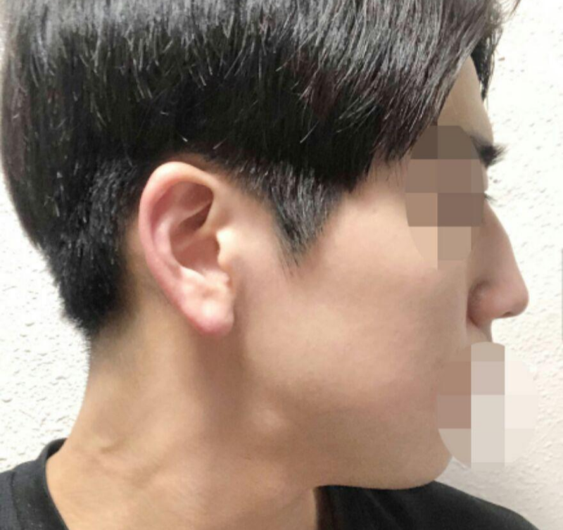 鼻筋、鼻先、ハンプ切除、鼻骨骨切り、団子鼻矯正