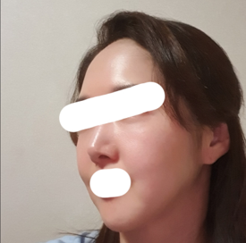 フェイスリフト再手術を受けて昔の写真を見たら満足^^