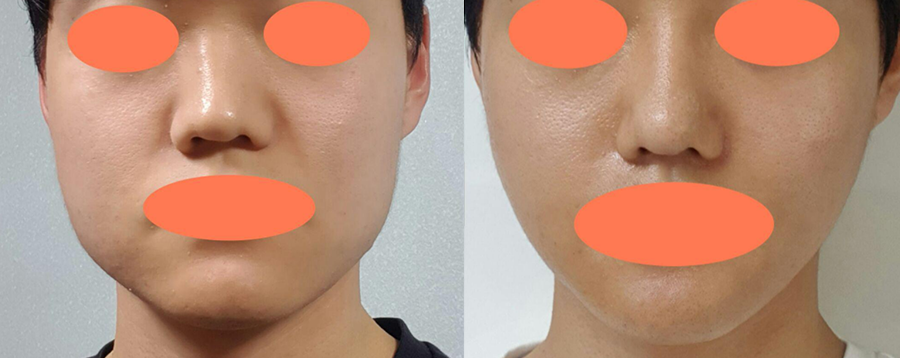 エラ削り、皮質骨切除、咬筋縮小