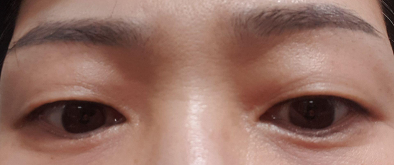 二重まぶた（切開）