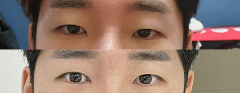 目つき矯正（部分切開）、目頭切開