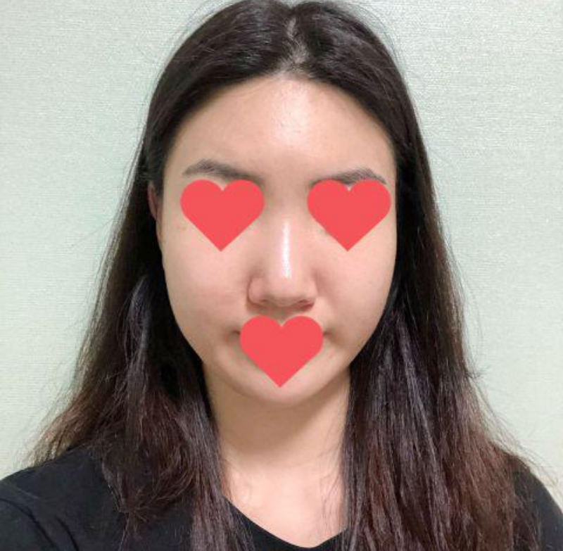 鼻の手術2年目のレビュー