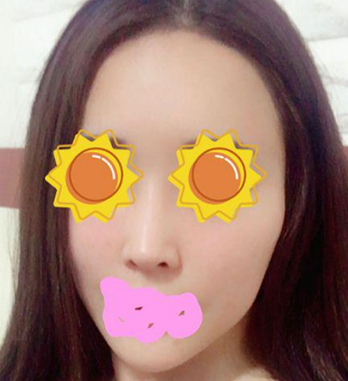 頬骨縮小手術1年半後のレビュー！