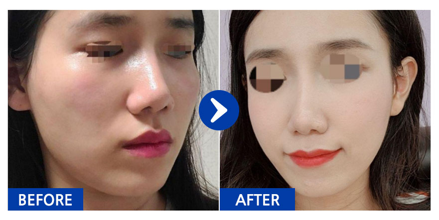 [바비톡] 안면윤곽 / 3개월차 / 닉네임 : dbdbdla