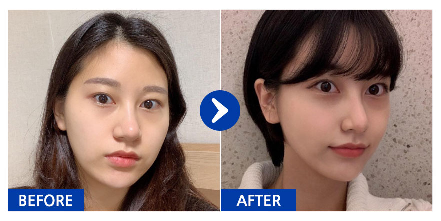 [바비톡] 안면윤곽, 지방이식 / 6개월차 / 닉네임 : 아멜리칼노