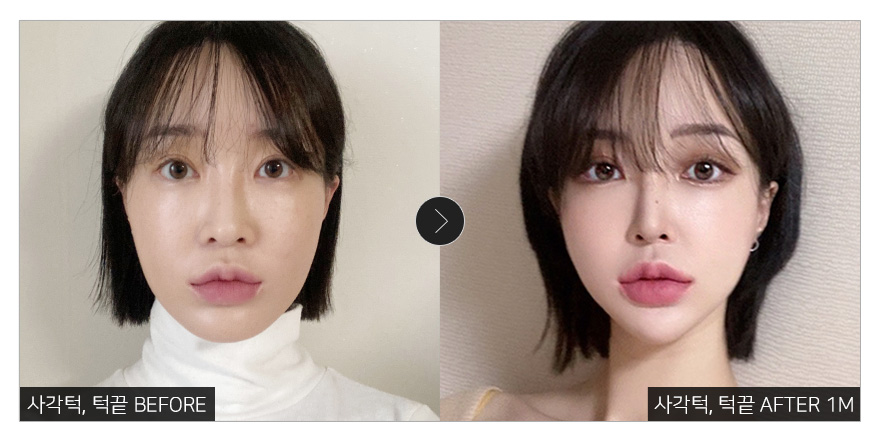 [강남언니 후기]  사각턱, 턱끝성형 한 달차 / 닉네임 : 곰돌이삼형제