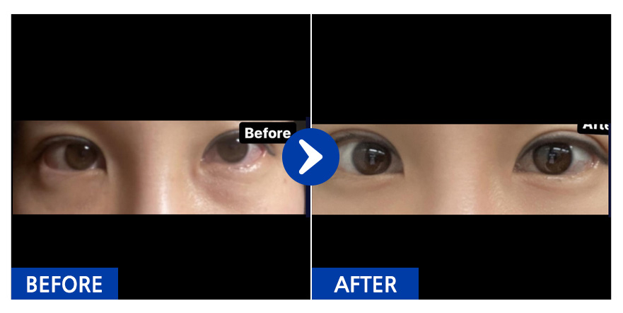 [바비톡] 쌍꺼풀 / 1개월차 / 닉네임 : 바비톡히