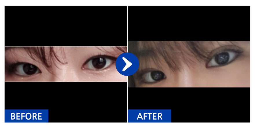 [강남언니] 자연유착 / 1개월차 / 닉네임 : 보라수건