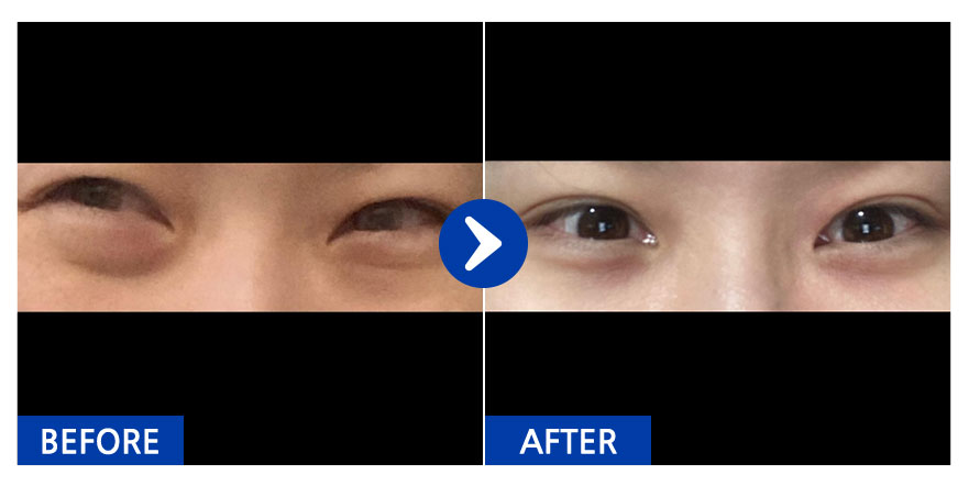 [강남언니] 눈밑지방재배치 / 2개월차 / 닉네임 : dbgcgghgfd