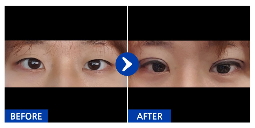 [강남언니] 자연유착 / 1개월차 / 닉네임 : ㅋㄱㅋㅋㄲ