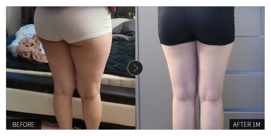 [강남언니 후기] 지방흡입 한 달차 / 닉네임 : 취저1017