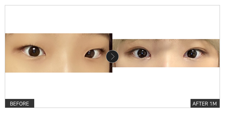 [강남언니 후기]  눈성형 한 달차 / 닉네임 : meyh