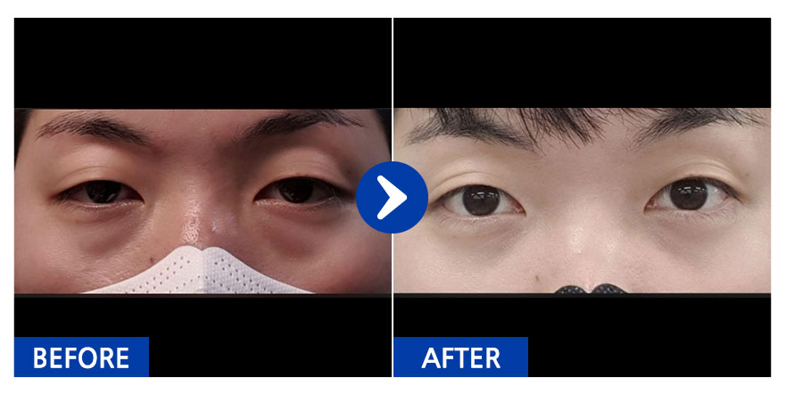 [바비톡] 눈지재 / 1개월차 / 닉네임:효듀리