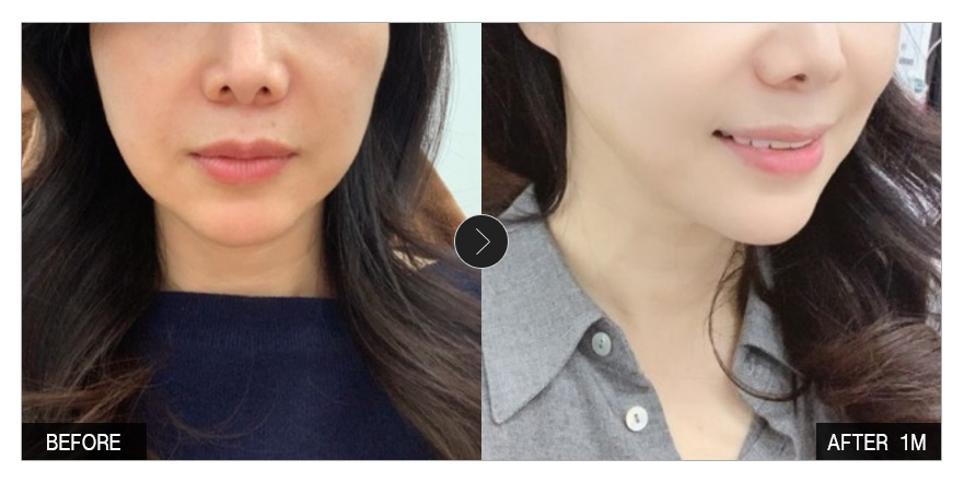 [강남언니 후기] 실리프팅 1개월차 / 닉네임 : sooeu