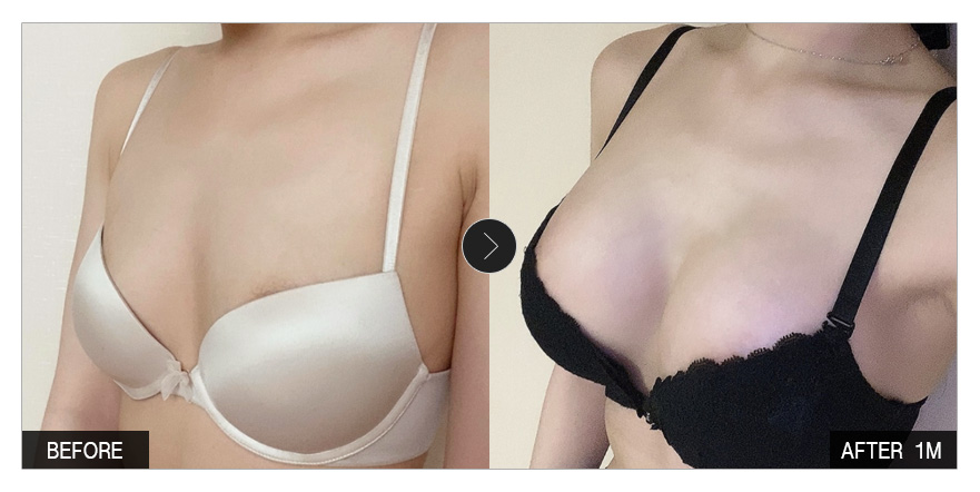 [강남언니 후기] 가슴성형 1개월차 / 닉네임 : 냠냠뇸뇸객