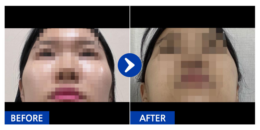 [강남언니] 안면윤곽(광대) / 3주차/ 닉네임: beami