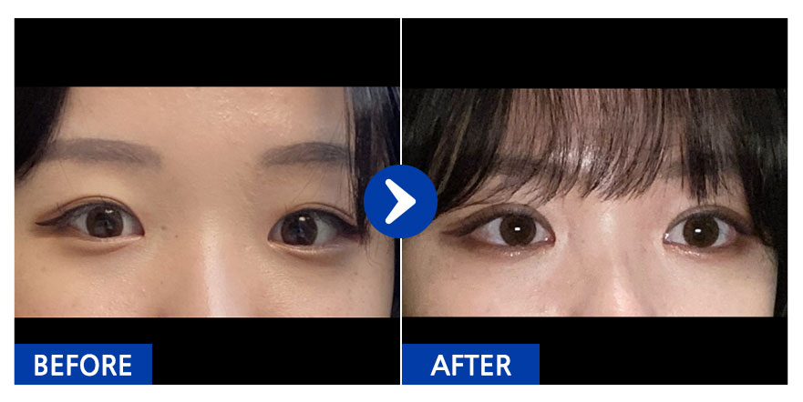 [강남언니] 쌍꺼풀 1개월차 /닉네임 : 쁘띠웅덩