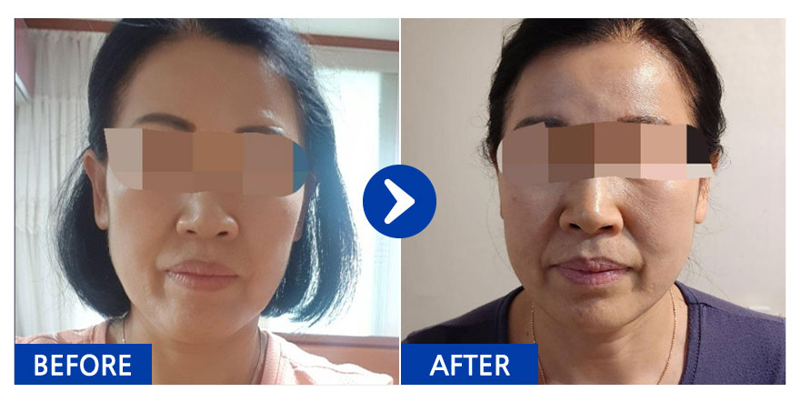 [바비톡] 실리프팅 1개월차 / 닉네임:냥이b6sKx