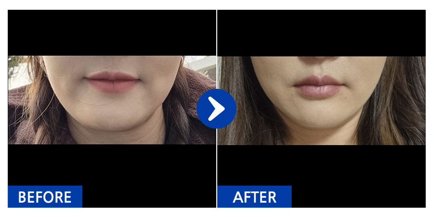 [강남언니] 실리프팅 1개월차 / 닉네임:이미선.