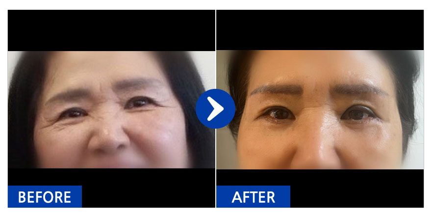 [강남언니] 눈썹거상술,하안검 / 1개월차 / 닉네임 : 잠실자네