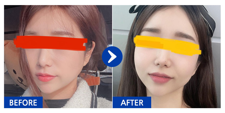 [바비톡] 풀페이스지방이식 / 1개월차 / 닉네임 : 주유비