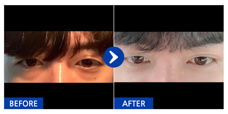 [강남언니] 눈밑지방재배치 / １개월차/ 닉네임:김동운