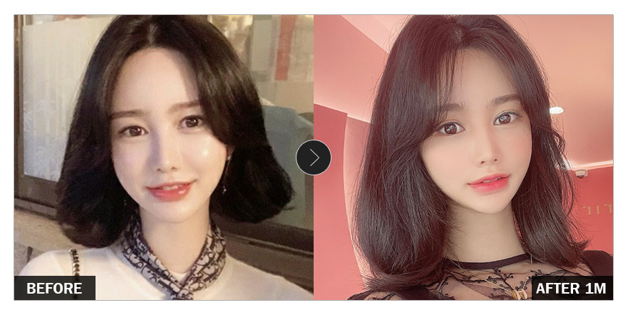 [바비톡 후기] 눈성형 한 달차 / 닉네임 : y3409