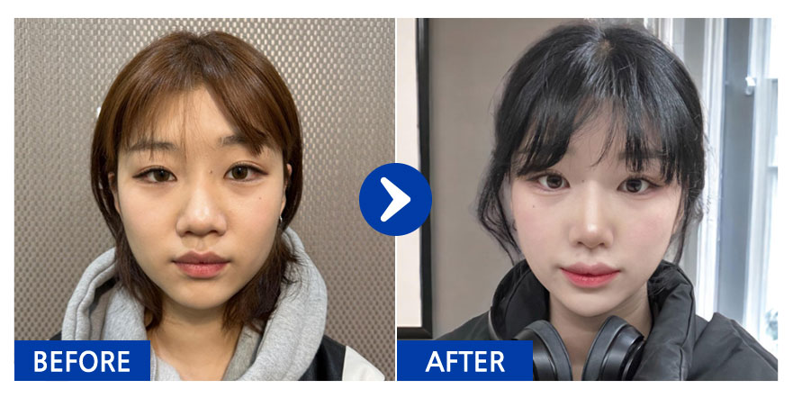 [바비톡] 코성형 / 1개월차 / 닉네임 : 나나나나나난니