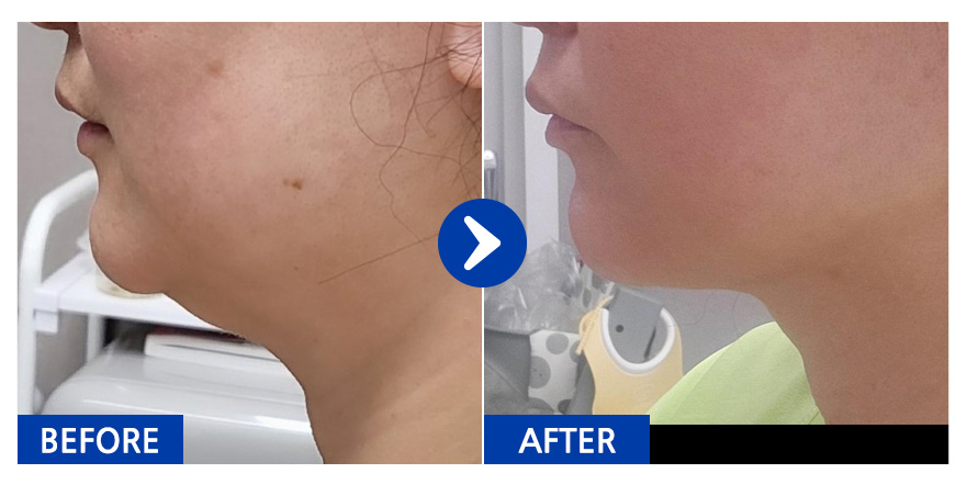 [강남언니 ] 지방흡입 / 1차 / 닉네임:서준사랑맘