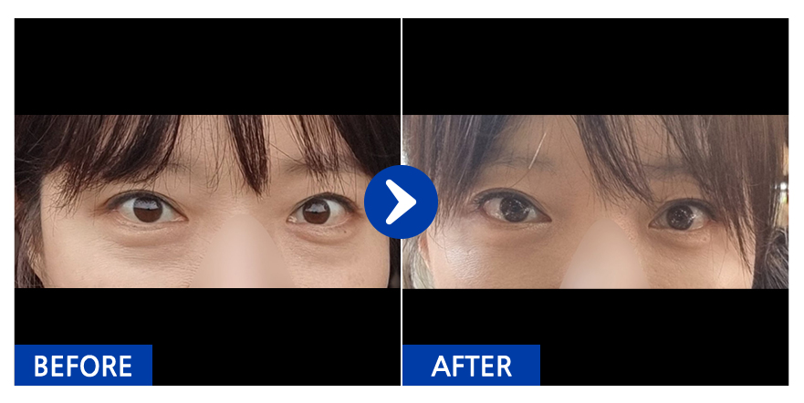 [강남언니] 눈밑지방재배치 / 1개월차 / 닉네임 : 아이스피아