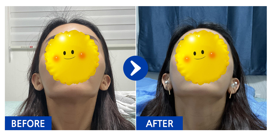 [바비톡] 광대축소 / 1개월차 / 닉네임 : 치이이이킨