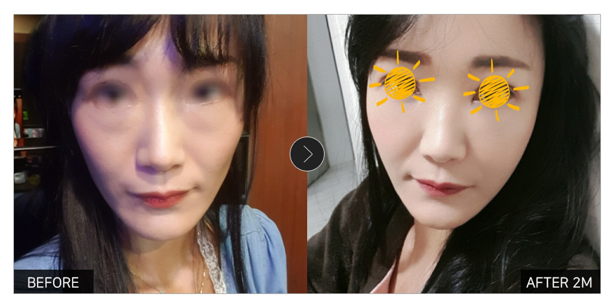 [강남언니 후기] 풀페지방이식+눈밑지방재배치 2개월차 / 닉네임 : 라비네