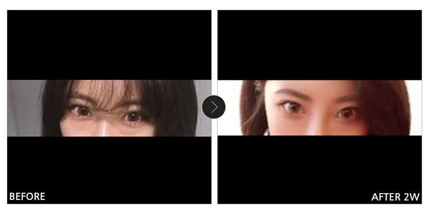 [바비톡 후기] 눈밑지방재배치 2주차 / 닉네임 : 매이라