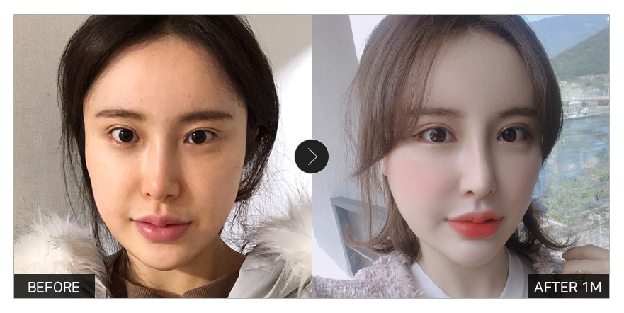 [강남언니 후기]  눈성형 한 달차 / 닉네임 : 2233332222