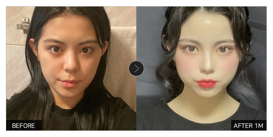 [강남언니 후기]  얼굴지방이식 한 달차 / 닉네임 : 담공마인두