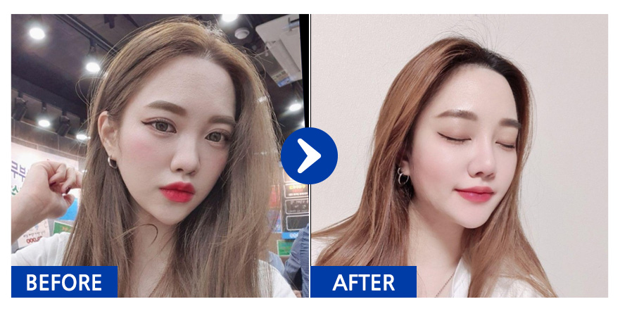 [바비톡] 코성형 / 5개월차/ 닉네임:둉둉이잉