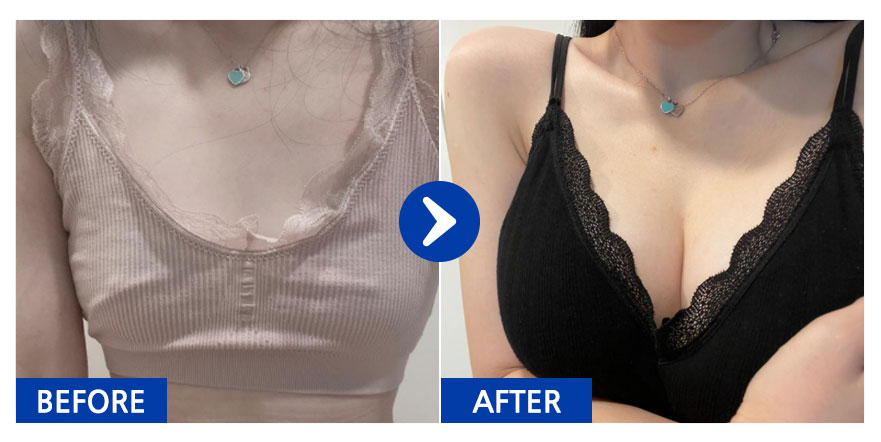 [강남언니] 가슴성형(세빈마텍) / 3개월차/ 닉네임:횬니횬니