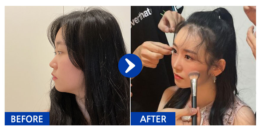 [강남언니] 코성형 / 4개월차/ 닉네임:횬니횬니