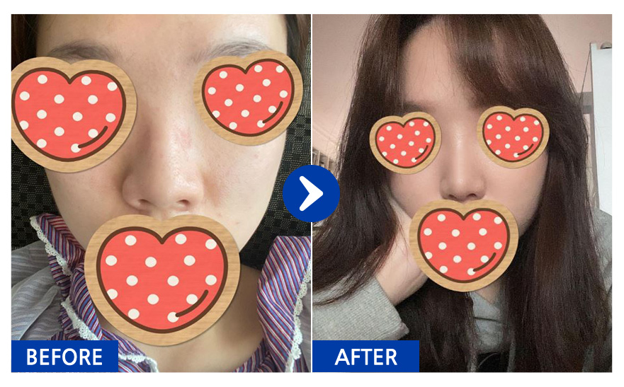 [바비톡] 코성형 / 3개월차/ 닉네임:아엊