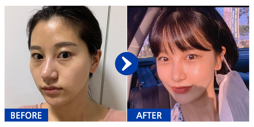 [바비톡] 지방이식 / 5개월차/ 닉네임:아멜리칼노