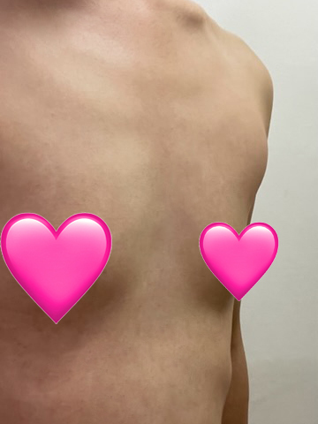 [豊胸] ネモビーム - 胸