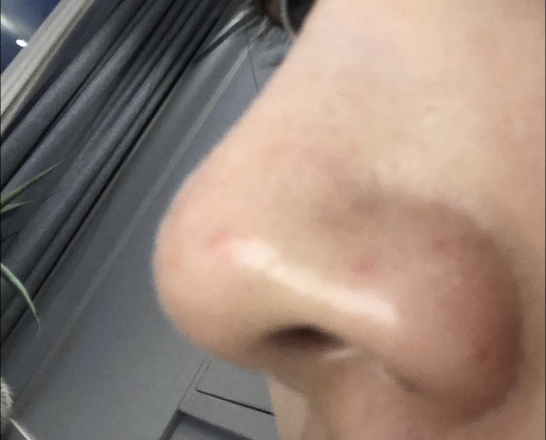 [プチ] ミン_ディ - 鼻の輪郭注射